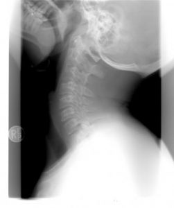 I Was in a Car Accident in Georgia and My Neck Hurts, What Should I Do?