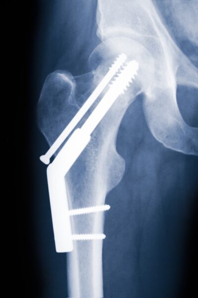 Hip x ray showing surgical implants