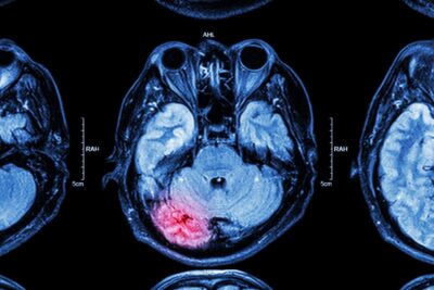 Mri showing brain injury