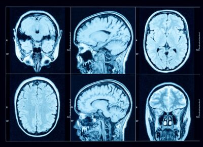 Ct scan of a brain