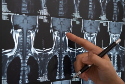 Mri of a persons vertebrae scaled