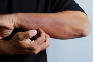 What Skin Conditions Qualify for Workers’ Compensation?